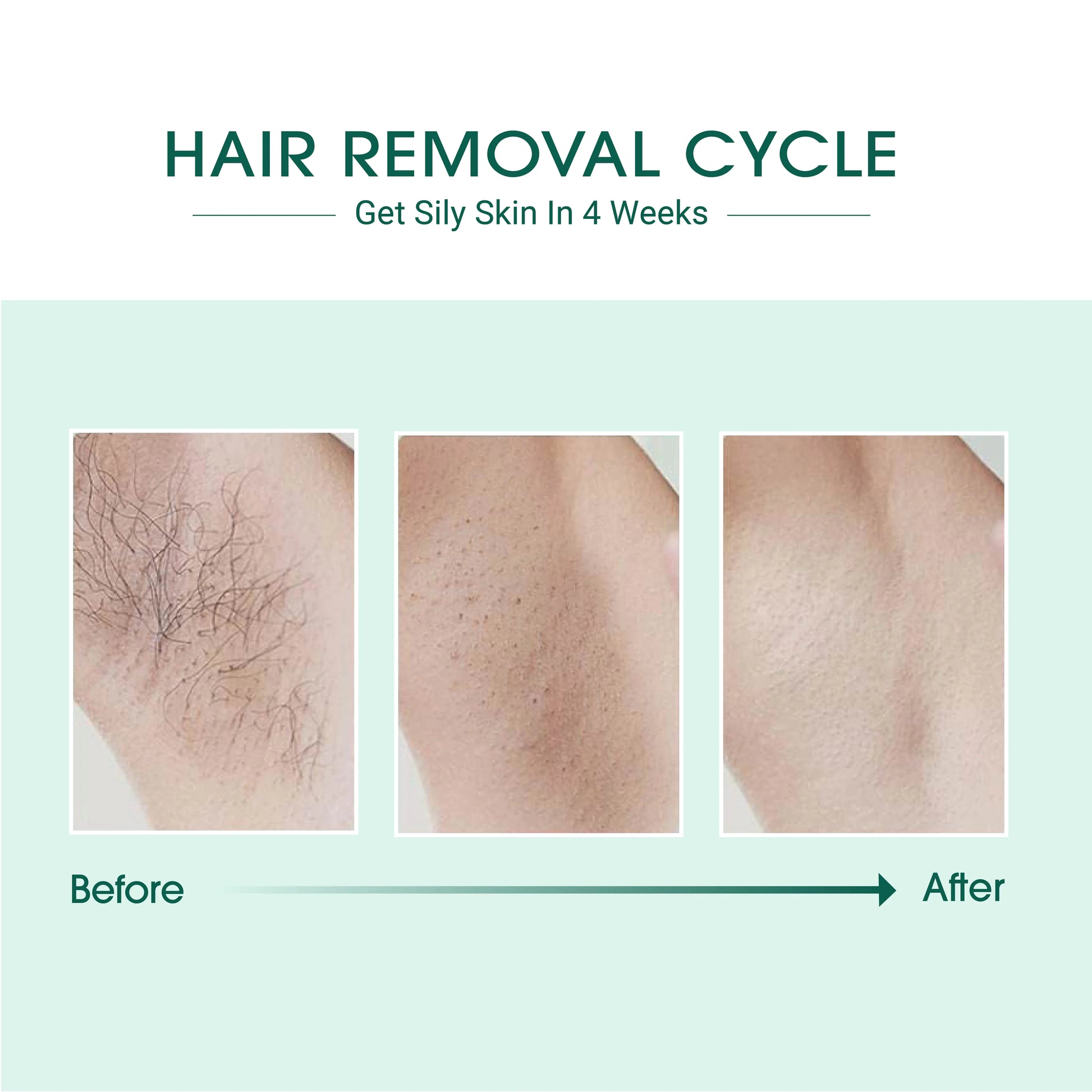 Laser IPL Hair Removal - Everpeakgoods